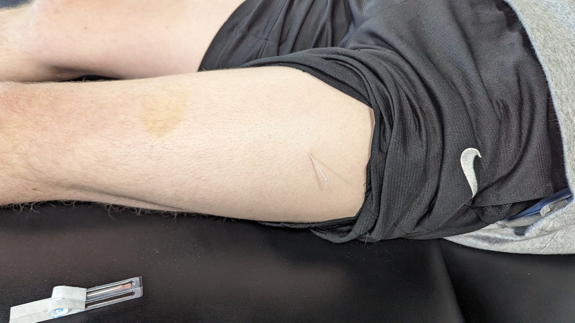 dry needling 