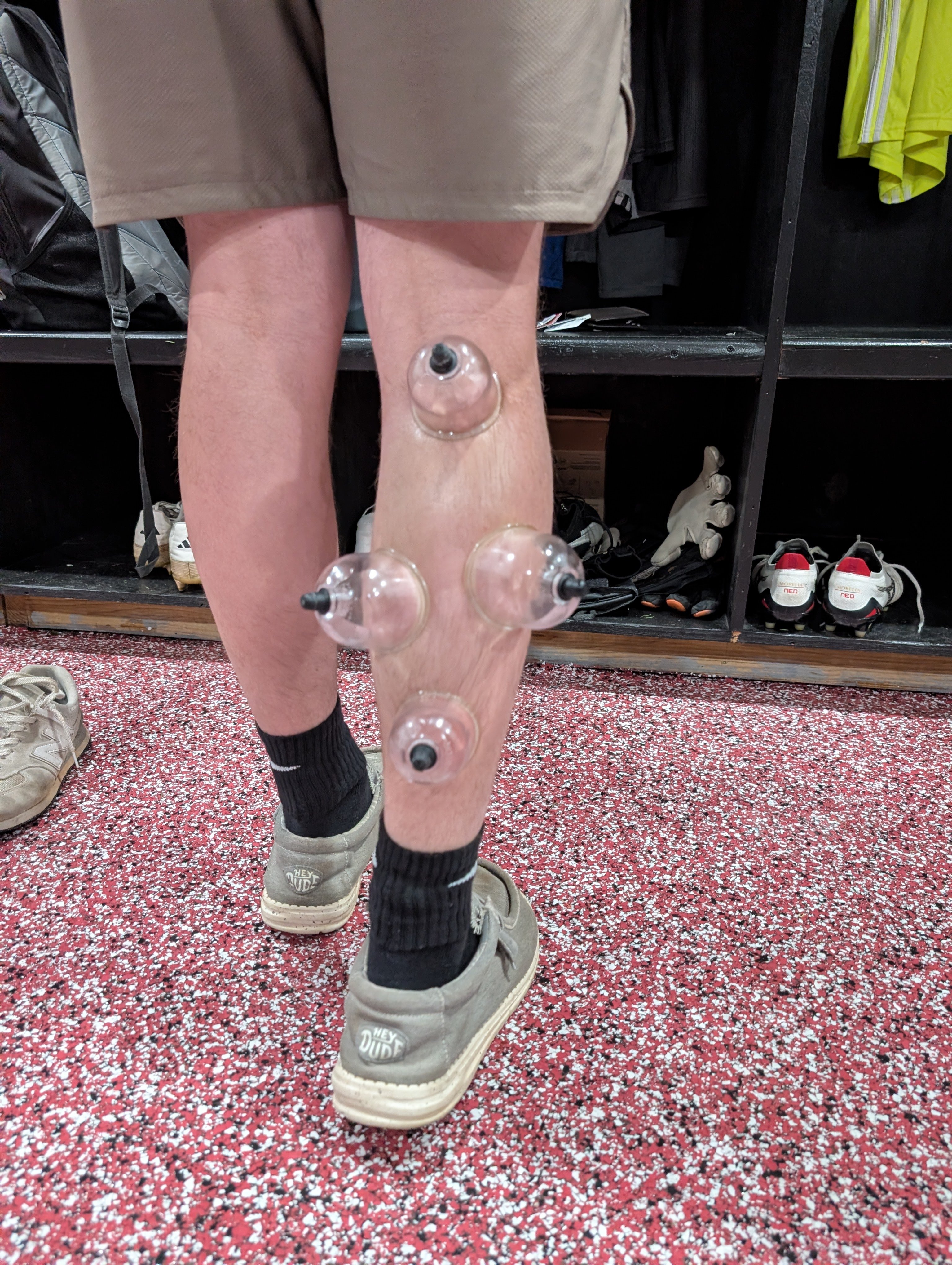 Patient working with a provider at a performance physical therapy clinic in Forest, VA during a running gait analysis